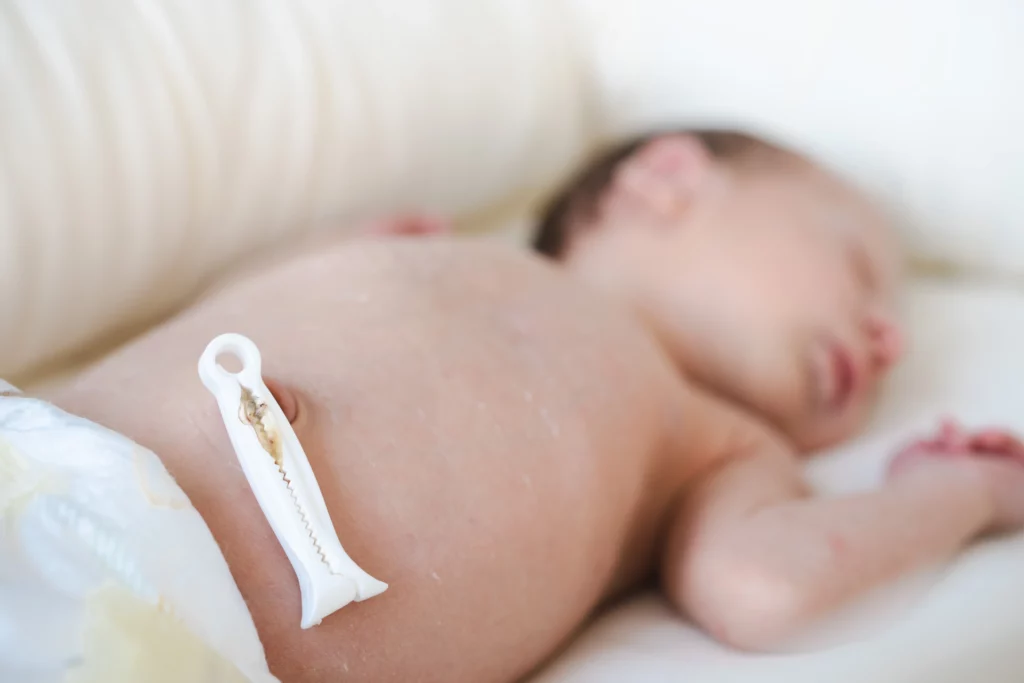 Sleeping newborn baby on a white blanket with visible umbilical cord clamp, symbolizing birth injury assessments.